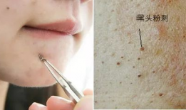 清理黑头粉刺视频,跟我学视频清洁术